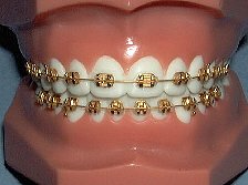 goldbraces.jpg - 10225 Bytes